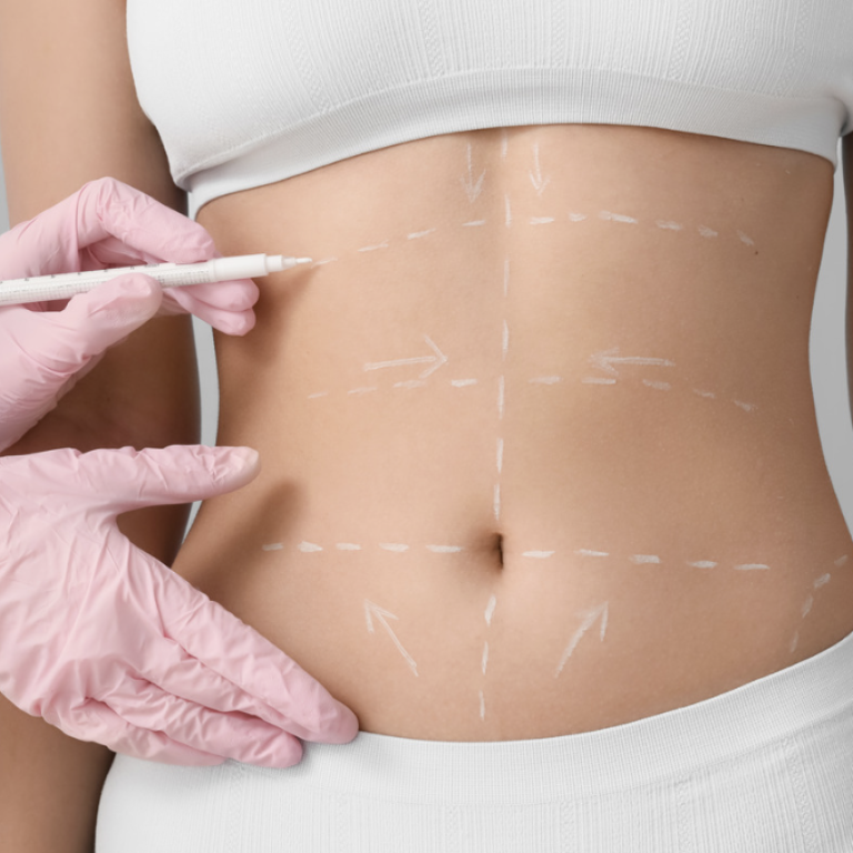 Free Liposuction Consultation in Alexandria Virginia